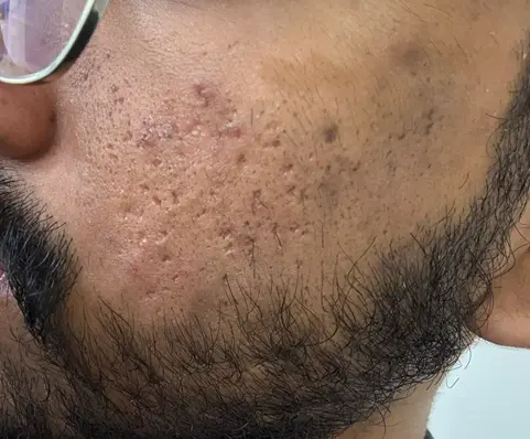 Before and after ice pick scars treatment by Dr. Amrika Seshadri
